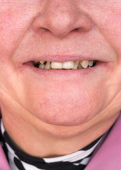 Fototapeta premium The teeth of the woman are processed and ready for prosthetics. Dental practice.