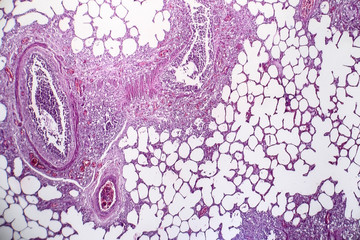 Histopathology of pneumonia, light micrograph, photo under microscope