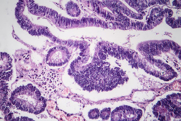 Histopathology of intestinal adenoma, light micrograph, photo under microscope