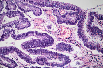 Histopathology of intestinal adenoma, light micrograph, photo under microscope