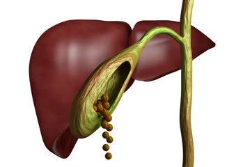 Gallstones in gallbladder and bile duct isolated white background