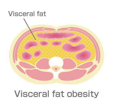 Type of obesity illustration . Abdominal sectional View (visceral fat ).