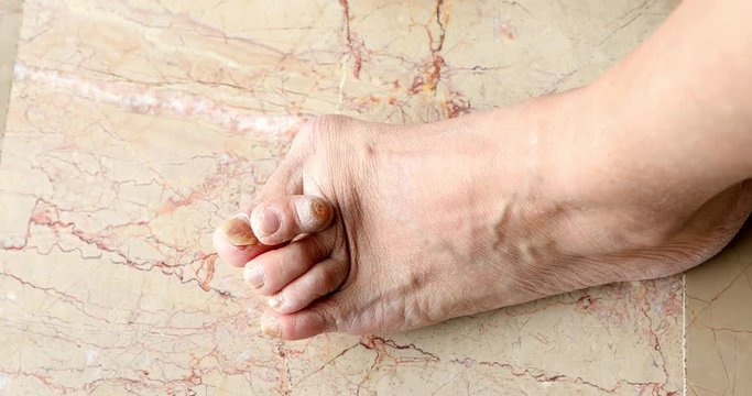 Female foots with bunion deformity