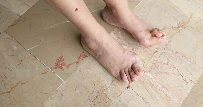 Female foots with bunion deformity