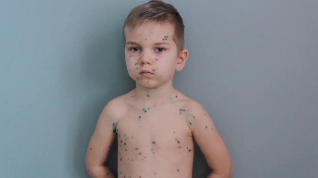 Sad Boy With Chickenpox. Sick Child Chicken Pox. Portrait of Young Boy Suffering From Chickenpox