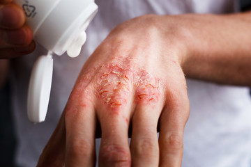 Eczema on the hands. The man applying the ointment , creams in the treatment of eczema, psoriasis...