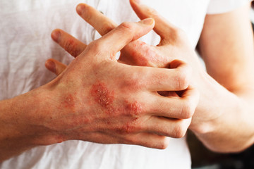 Man scratch oneself, dry flaky skin on hand with psoriasis vulgaris, eczema and other skin conditions like fungus, plaque, rash and patches. Autoimmune genetic disease. - obrazy, fototapety, plakaty