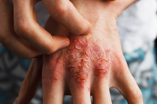 Man scratch oneself, dry flaky skin on hand with psoriasis vulgaris, eczema and other skin conditions like fungus, plaque, rash and patches. Autoimmune genetic disease.