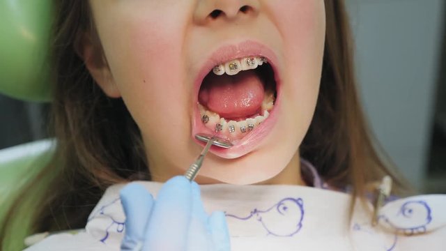 Close-up shot examination of the teeth of a girl with braces attached