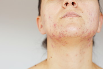 Acne on the face of young women. Improper therapy has led to a severe form of chronic inflammation...