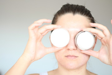 Acne on the face of young women. Improper therapy has led to a severe form of chronic inflammation...