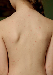 Naklejka premium The back of a child who has a chickenpox blister or chickenpox