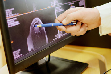 Doctor pointing a shoulder MRI picture on the screen.