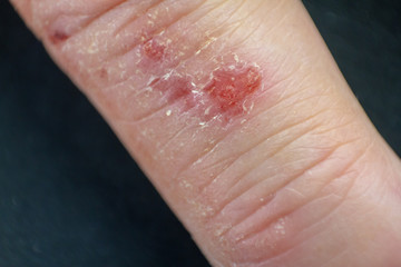 Hand dermatitis. Finger eczema