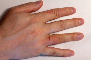 Hand dermatitis. Finger eczema