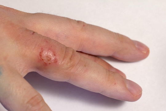 Hand dermatitis. Finger eczema