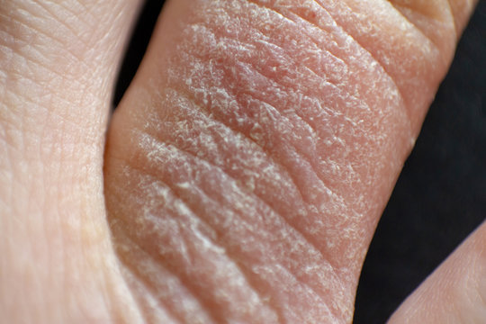 Hand dermatitis. Finger eczema