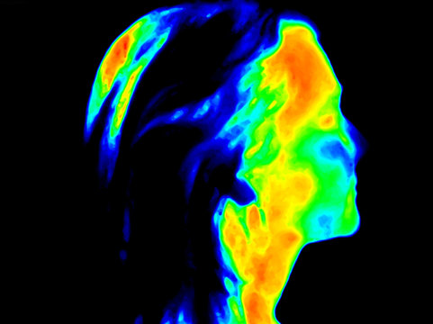 Thermographic image of the right side of the face of a woman with the photo showing different temperature in a range of colors from blue showing cold to red showing hot which can be joint inflammation