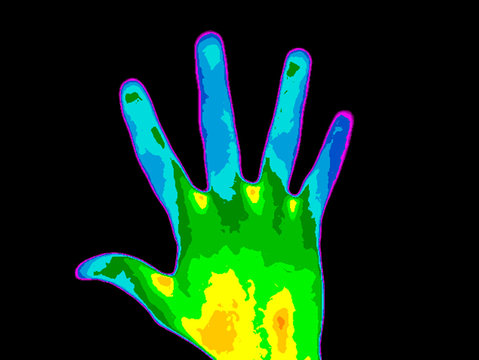 Thermographic photo of the palm of a persons hand, the photo showing different temperature in a range of colors from blue showing cold to red showing hot, blue fingers can indicate multiple sclerosis.