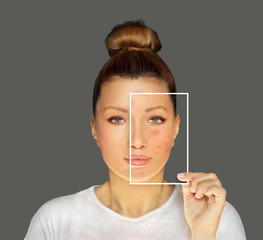 Post-Acne Marks /Treating Acne Scars