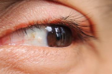 close up Blepharitis or Eyelid inflammation eyes healthy concept