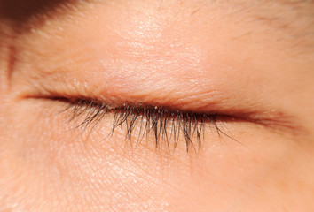 Fototapeta na wymiar close up Blepharitis or Eyelid inflammation eyes healthy concept