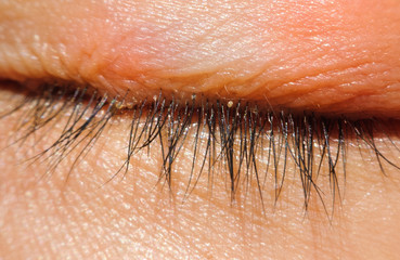 close up Blepharitis or Eyelid inflammation eyes healthy concept