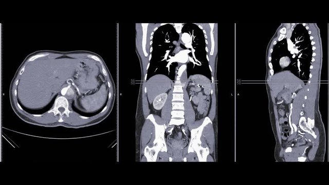 Computed tomography of CTA abdominal aorta coronal plane , axial coronal and sagittal 3D rendering image . 