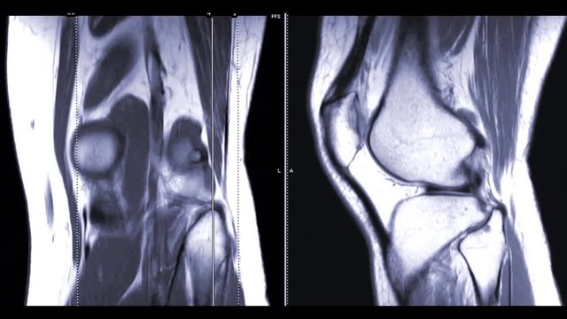 magnetic resonance imaging or MRI Knee  coronal and sagittal plane comparison for diagnosis sport trauma and damage of cross-shaped ligaments 