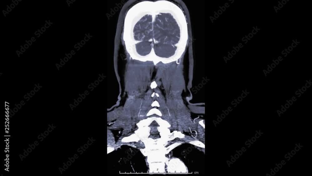 Poster computed tomography angiography, cta brain 3d rendering image coronal view in sagittal plane left to