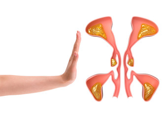 nasal sinus with internal demonstration of sinusitis, facial inflammation that causes headache and malaise