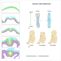 Nutrition and the Neural Tube. Neural tube formation.  anencephaly. Folic acid. biosynthesis of DNA. planning pregnancy. neural tube disease.  birth defect