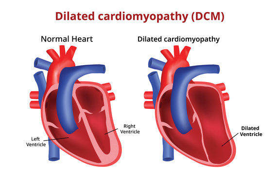 Dilated cardiomyopathy, Heart disease, Vector image