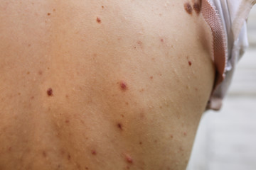 Fototapeta premium Many birthmarks on the girl's back. Medical health photo. Woman's oily skin with problems acne.