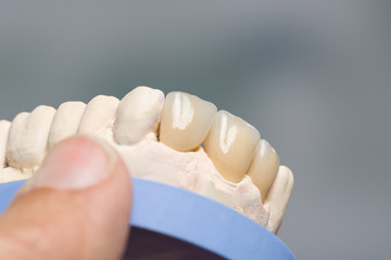 Close up of artificial dentition on a dental imprint in a dental laboratory