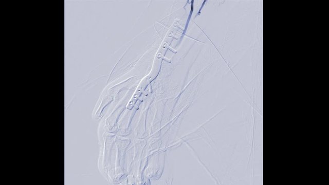fluoroscopic image of Vessel in the Hand or angioplasty of ulna artery on screen in intervention radiology room.