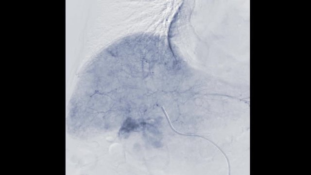 transcatheter oily chemoembolization or TOCE with Fluoroscopic guided peripheral intervention of the hepatic artery  on the monitor.