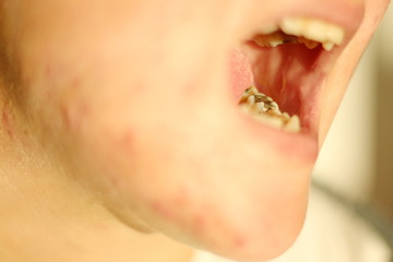 Problem with teeth in young women.