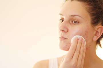 Acne on the face of young women. Improper therapy has led to a severe form of chronic inflammation face