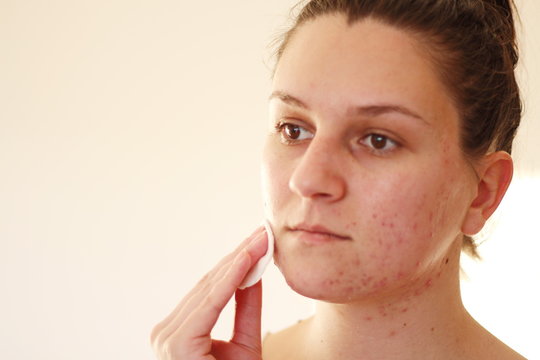 Acne On The Face Of Young Women. Improper Therapy Has Led To A Severe Form Of Chronic Inflammation Face