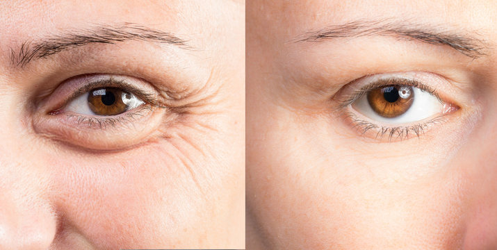 Wrinkled eye of beautiful lady before and after cosmetic treatment