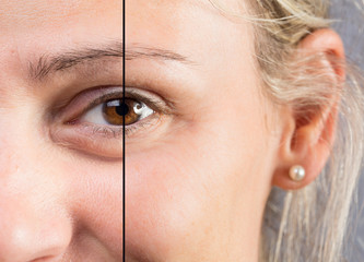 Blonde caucasian woman close up showing eye before and after aesthetic treatment