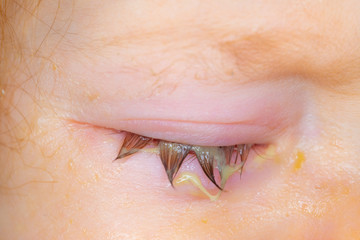 Swollen and sticky eyelid of a small baby with conjunctivitis
