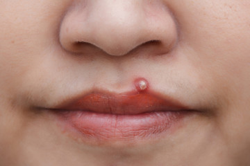 Fototapeta premium Inflammatory acne on woman mouse