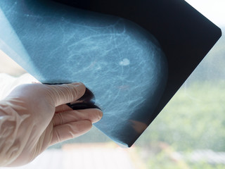 Mammography. The doctor's hand holding the pictures. The doctor examines the pictures in the...