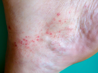 Fototapeta premium Allergic rash in the ankle joint area of the lower limb to the effect of chemical preparations. Condition after application of warming compresses. The concept of dermatology.