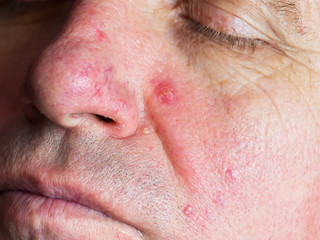 Demodecosis of the face. Reddened, inflamed skin. Pustular eruptions. Manifestation of small veins on the surface.