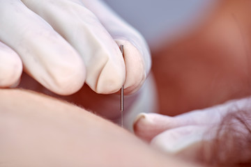 Chiropractor doing dry needling, closeup of a needle and hands. Physiotherapist, osteopath, manual therapy, acupressure. Acupuncture, alternative medicine.