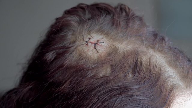 two stitches on the girl's head after surgery to remove a wen. shaved hair around the wound