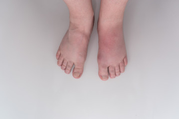 Füße mit Gichtanfall